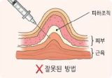 잘못된 투여 방법