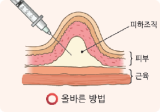 올바른 투여 방법